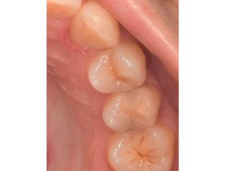 30代女性「虫歯を白く治してほしい」天然歯のような耐久性と白さを再現できるセラミック「e-max」で修復した症例