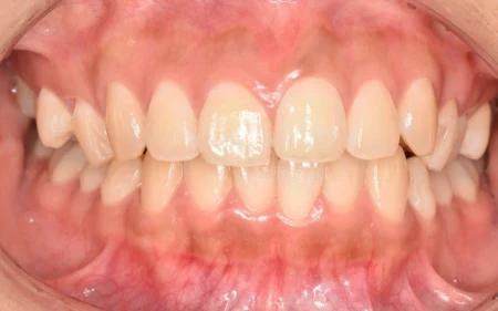 20代女性「結婚式に向けて歯を白くしたい」高濃度の漂白成分を含む薬剤を使って歯科医院で行う「オフィスホワイトニング」で歯の色をトーンアップした症例