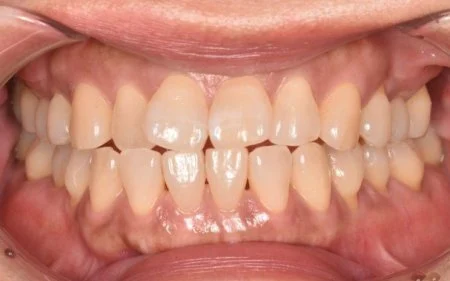 40代女性「歯を白くしたい」歯科医院で専用の薬液を使用して歯を白くする「オフィスホワイトニング」の3回コースで、明るい口元にした症例