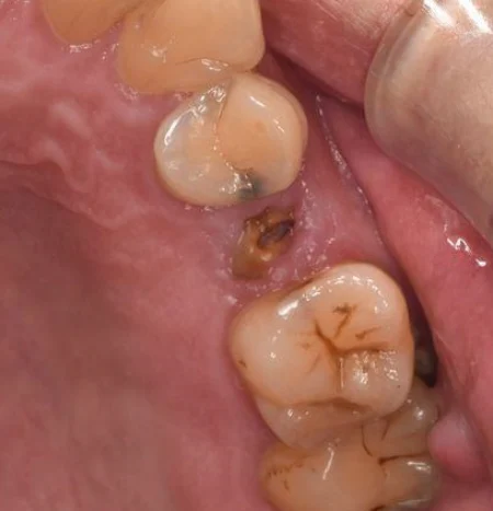 70代男性「歯医者は何十年かぶり。悪い所を治したい」根っこのみだった左上奥歯を抜いた後、人工ダイヤモンド「フルジルコニア」のブリッジで治し、自然な見た目で良く噛めるようになった症例