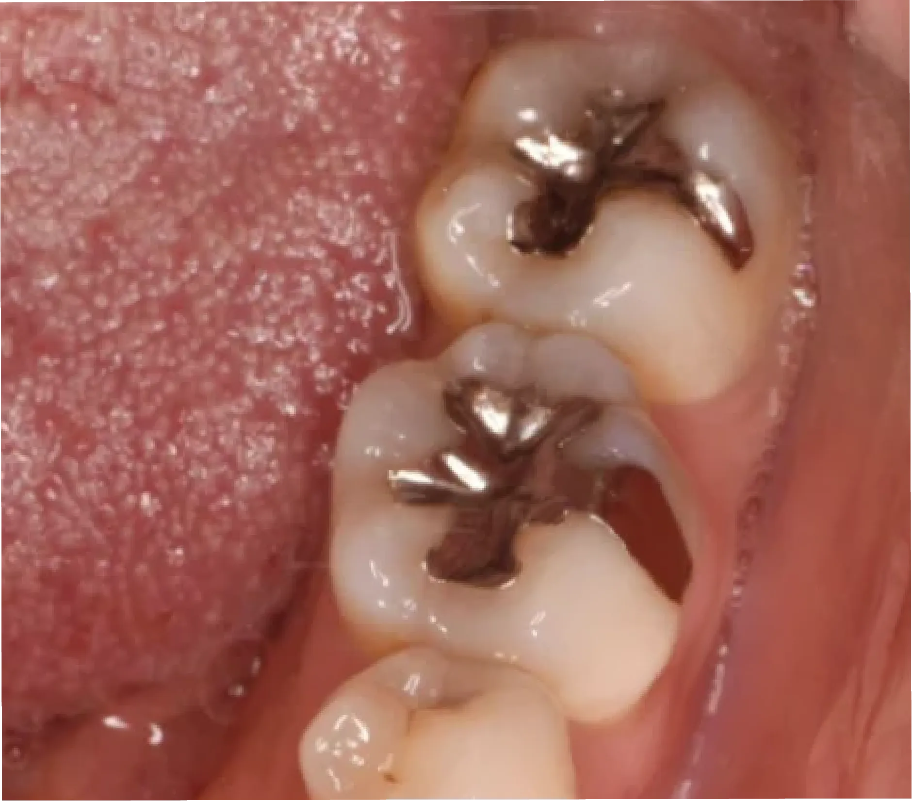 30代女性「左下の歯が痛い」詰め物の下で広がっていた虫歯を取り除き、ガラスセラミック「e-max」で修復した症例