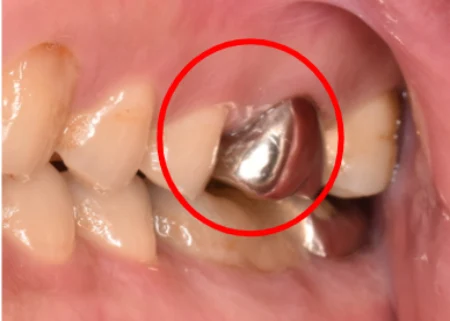 40代男性「銀歯を白い歯に変えたい」金属の被せ物を外し、自然な白さで強度もある「フルジルコニアクラウン」で周りの歯と色を合わせた症例