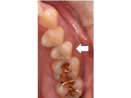30代女性「左上の歯が2日前から痛む」神経まで達した虫歯を取り除き、自然な色の被せ物「オールセラミッククラウン」で美しく修復した症例
