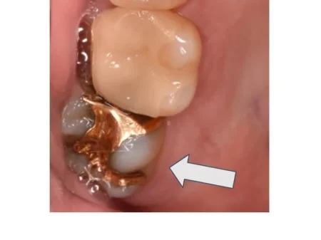 30代男性「詰め物が浮き上がっている気がする」合わなくなったゴールドの詰め物を外して虫歯を取り除き、自然な白さで強度もあるセラミックの「E-maxインレー」で修復した症例