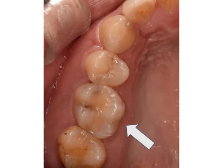 30代女性「上の奥歯がしみて痛い」やや深い虫歯を取り除き、目立ちにくい白さで強度もあるセラミックの詰め物「E-maxインレー」で修復した症例
