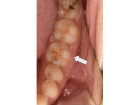 30代女性「歯が痛い」徹底的に虫歯除去した部分を、白くてなじみがいいセラミック素材の詰め物「E-maxインレー」で治療した症例