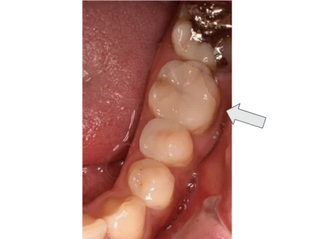 30代男性「左下の詰め物が欠けた」透明感のある白さで耐久性の高いガラスセラミック「e-max」で綺麗に作り直した症例