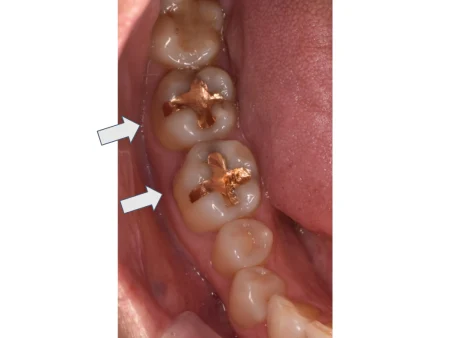 30代女性「ゴールドの詰め物を白くしたい」金属で治療した歯を、目立ちにくい白さで強度もあるセラミックの詰め物「E-maxインレー」に替えて自然な見た目にした症例