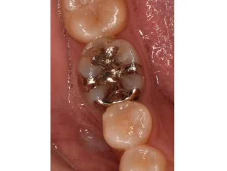 30代女性「虫歯の治療を何度もしている」銀歯の下の虫歯を取り除き、虫歯になりにくく目立たない白さのセラミックの詰め物「E-maxインレー」で修復した症例