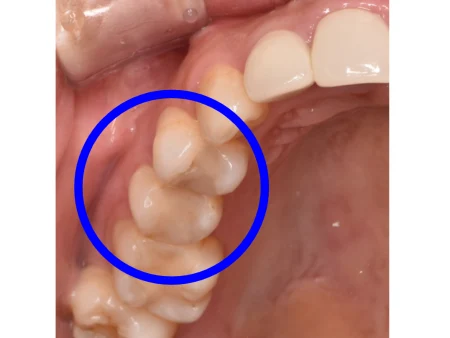30代男性「歯がしみる」繰り返していた虫歯を取り除き、細菌が付着しにくく強度もあるセラミック「E-maxインレー」で見た目もきれいに修復した症例