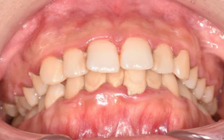 20代女性「歯科検診をしてほしい」約10年ぶりの歯医者で、全体的に付着した歯石の除去と、ブラッシング指導による歯周病治療を行った症例