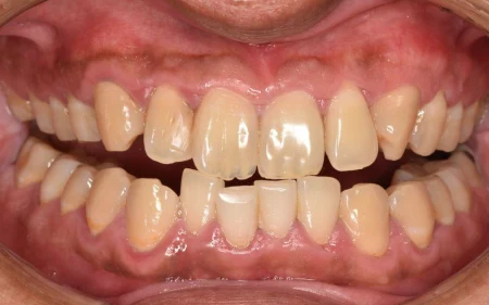 30代男性「検診をしてほしい」歯茎の炎症と付着していた歯石を、ブラッシング指導と歯石除去による歯周病治療で改善した症例
