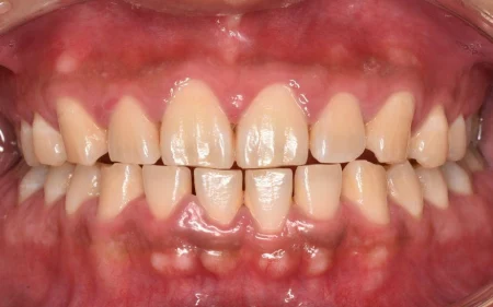 30代男性「歯が痛い。口の中全体をチェックしたい」虫歯の検診時に見つかった歯茎の炎症を、歯科医院でのクリーニングとご自宅でのブラッシングで改善した症例