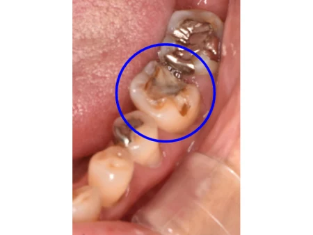 60代女性「奥歯の詰め物が外れた」再び虫歯になった歯を、適合が良く虫歯になりにくいセラミックの「E-maxインレー」で見た目も自然に治療した症例