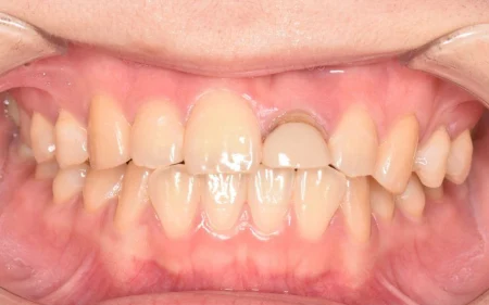 10代女性「以前治療した前歯が気になる。インプラントも検討している」白い土台と「オールセラミッククラウン」で被せ物を作り直し、歯ぐきの形を整えて自然な見た目になった症例