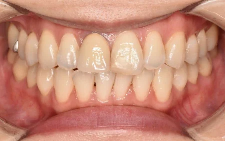 30代女性「ホワイトニング後、前歯の色浮きが気になる」色味が合っていなかった被せ物を「オールセラミック」で作り直し、統一感のある自然な見た目に改善した症例