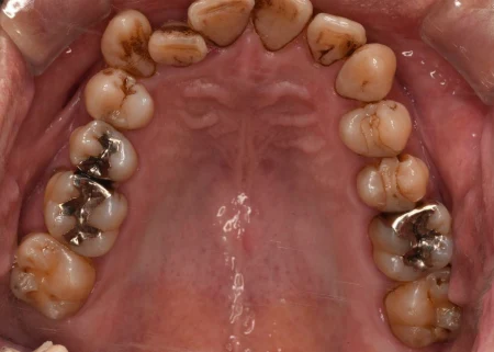 50代男性「着色を落として、詰め物もやり直したい」歯周病治療と専用機械による着色除去を並行し、歯と歯肉の状態を改善して詰め物をやり直す準備ができた症例