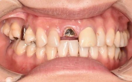 30代女性「前歯が土台ごと取れた」樹脂製の「ファイバーコア」で土台を作った後、白く透明感がある「オールセラミック」で被せ直し、自然で美しい見た目に修復した症例